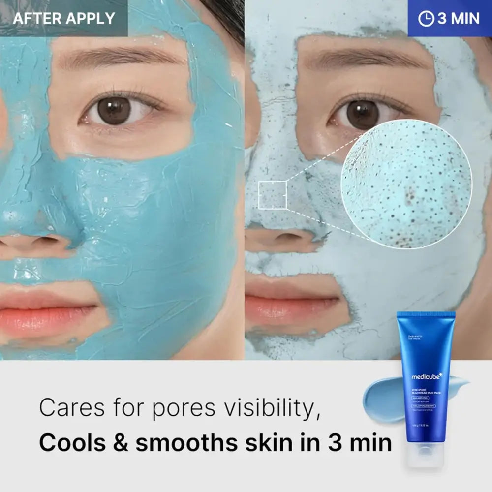 Blue textured zero pore blackhead mud mask applied to skin for deep cleansing and blackhead removal use
