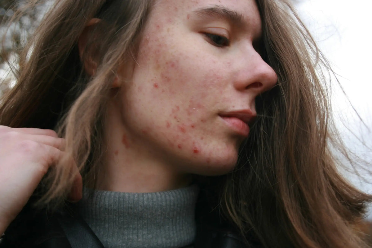 Is Centella Good for Acne? Benefits How It Works &