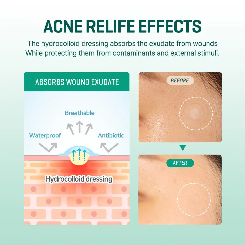 30 Days Miracle Clear Spot Patch - Treatment SomeByMi Acne Patches