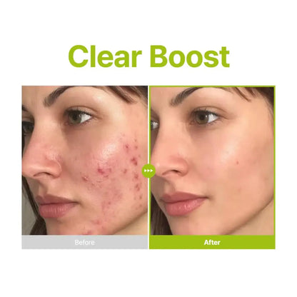 Azelaic acid 10 kojic tea tree serum 30ml with tea tree oil shown in before and after acne treatment results on face