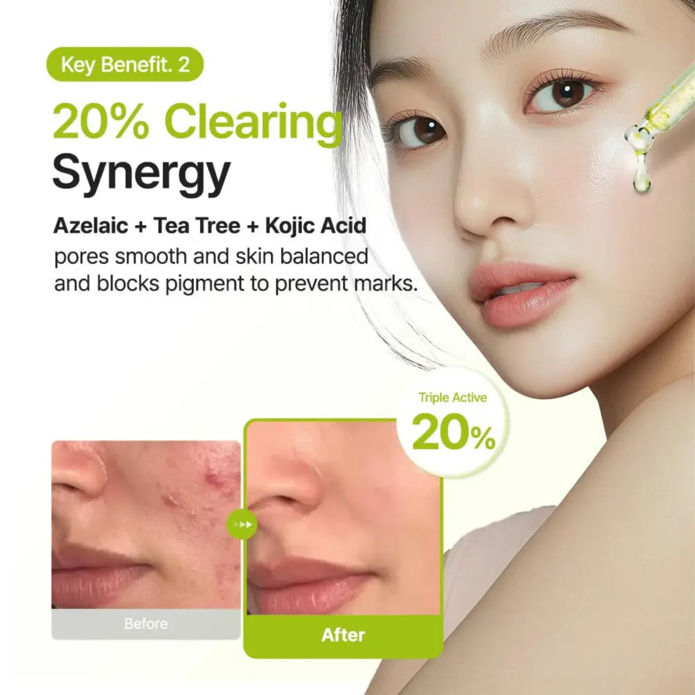 A clear glass dropper with golden tip filled with light yellow azelaic acid 10 kojic tea tree serum 30ml liquid