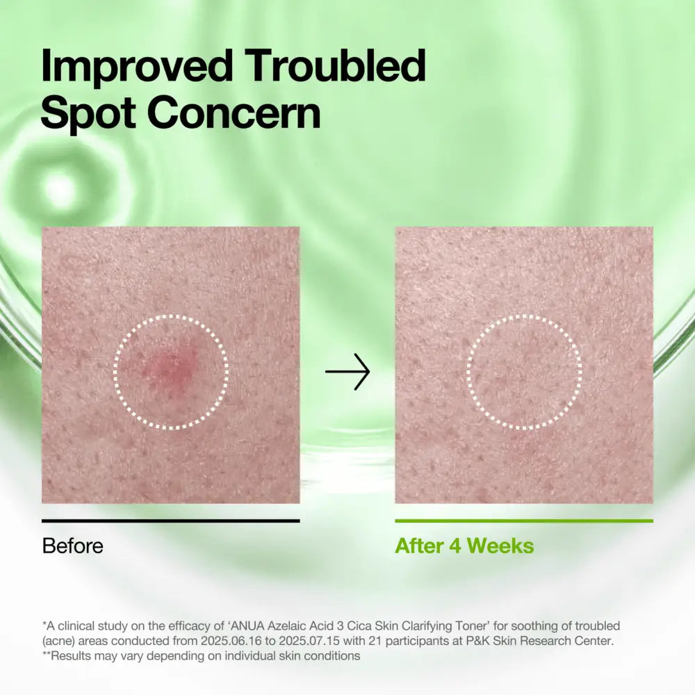 The anua azelaic acid 3 cica skin clarifying toner is a clear liquid in a transparent bottle with a white pump dispenser