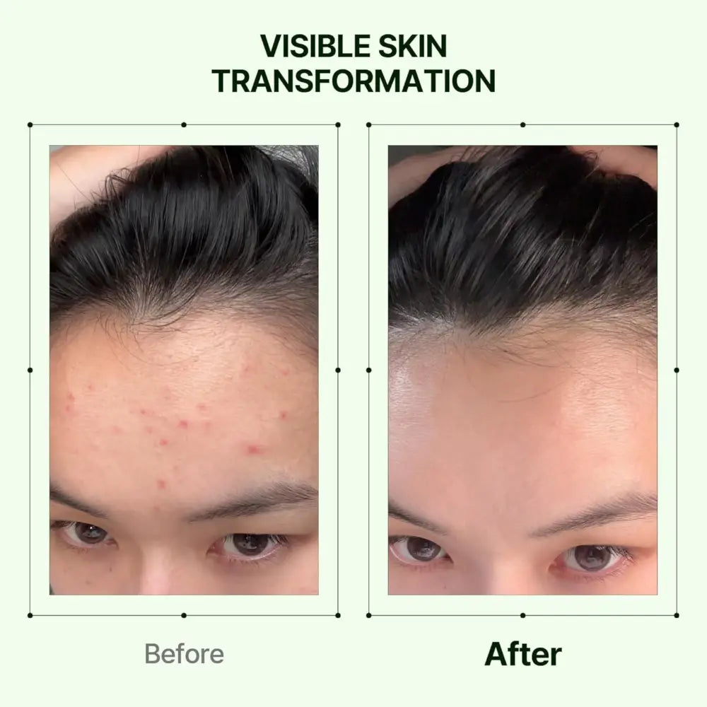 Before and after skin transformation using mugwort soothe in toner 160ml from the best korean skincare brands sa