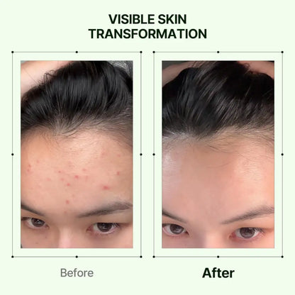 Before and after skin transformation using mugwort soothe in toner 160ml from the best korean skincare brands sa