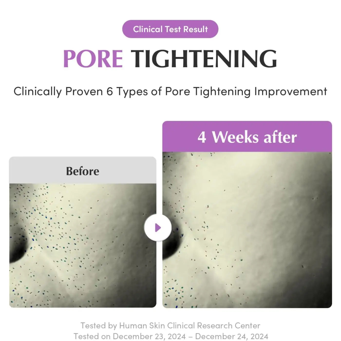 Before and after skin texture results of purple pdrn pore minimizing serum from best korean skincare brands sa after four weeks