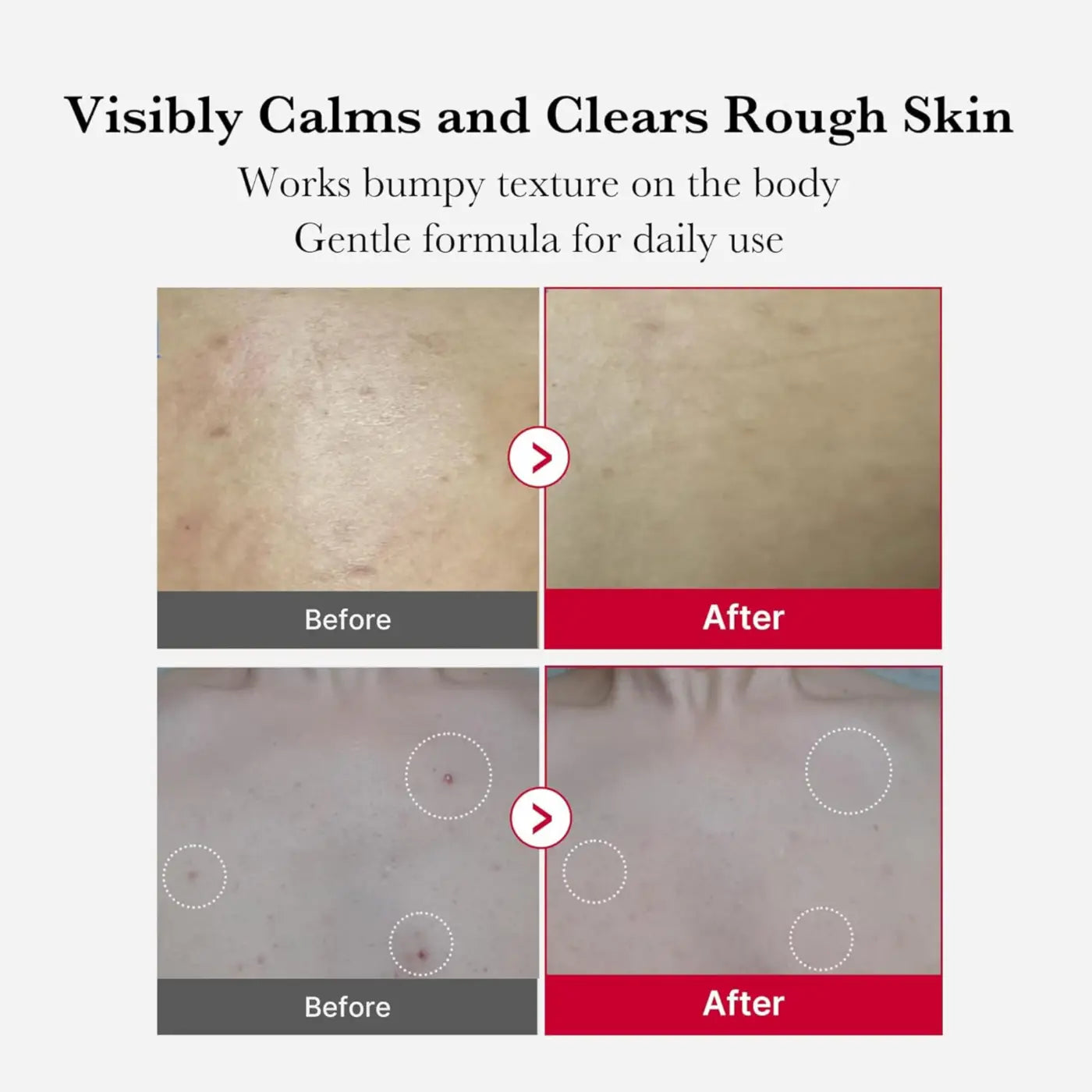 Gentle red acne body peeling shot 110g body lotion with soothing formula to calm and clear rough bumpy skin