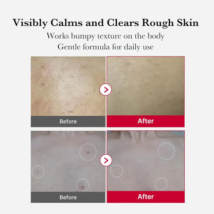 Gentle red acne body peeling shot 110g body lotion with soothing formula to calm and clear rough bumpy skin